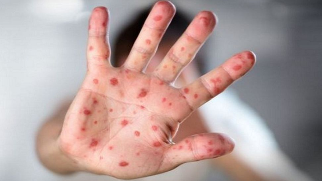 হামের প্রাদুর্ভাব: ২৪ ঘণ্টায় আরও ৭ মৃত্যু, সংক্রমণ বেড়েই চলেছে হামের প্রাদুর্ভাব: ২৪ ঘণ্টায় আরও ৭ মৃত্যু, সংক্রমণ বেড়েই চলেছে